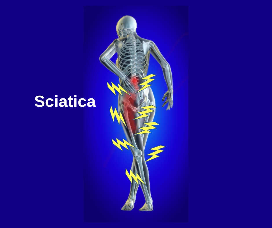 Don't Suffer With Pain From Sciatica - Greenwich Kinetics-Dr. Buonanno